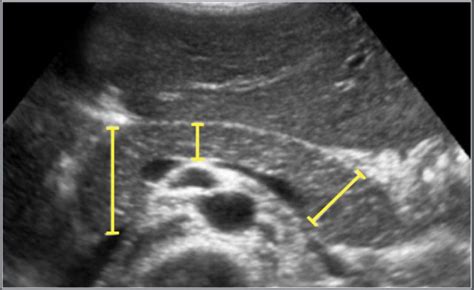 Abnormal Pancreas Ultrasound