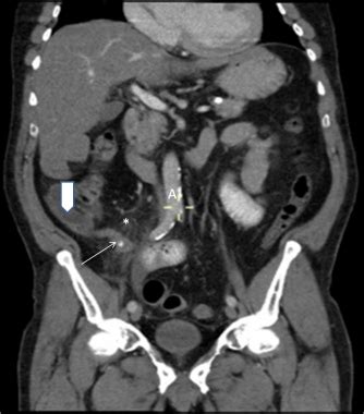 Lung Ct Scan Without Contrast