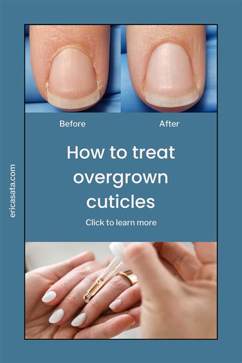 Cuticle Care For Infection at elenajflanagano blog