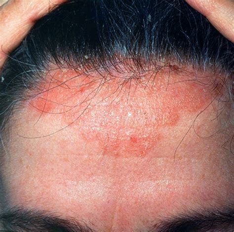 scabies on the scalp - pictures, photos