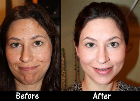 Jessner Peel Photos: A Blogger's Before & After Guide to Chemical Peels