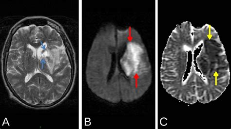 Left MCA Infarct with Hyperdense MCA Sign