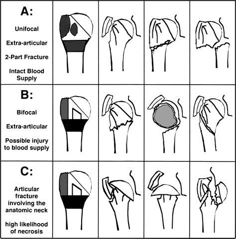 Classification and Imaging of Proximal Humerus Fractures - Orthopedic ...