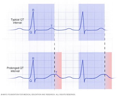 Long QT syndrome - Symptoms and causes - Mayo Clinic