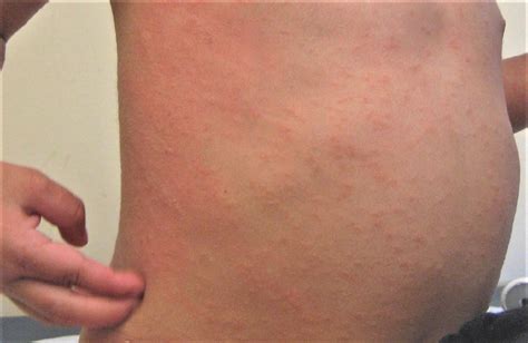 Pruritic rash definition, causes, diagnosis, treatment & prognosis