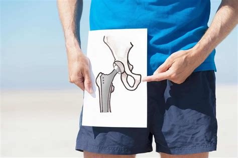 9 Must-Do Exercises Before A Hip Replacement Surgery