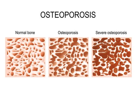 The Importance of Having a Bone Density Test