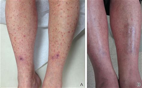 Vasculitis Of The Skin Pictures