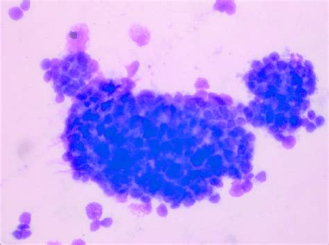 Photomicrograph of pleural fluid cytology showing tight cluster of ...