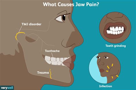 Temporomandibular Joint Disorder (TMJ): Overview and More