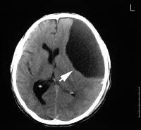 What Is Arachnoid Cyst