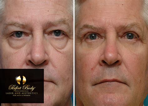 Ultherapy Laser Skin Tightening For The Face - Perfect Body Laser ...