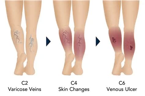 Chronic Venous Insufficiency Stages Explained