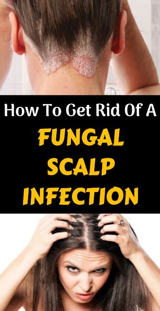 How To Get Rid Of A Fungal Scalp Infection