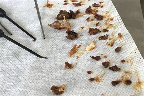 Expert removes 16 years worth of built-up ear wax in man's ear