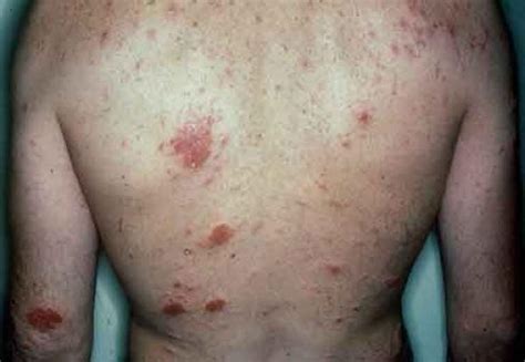 What causes Eczema? – What causes this?