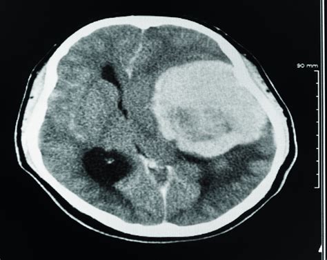 Can a CT Scan Detect a Brain Tumor? » Scary Symptoms