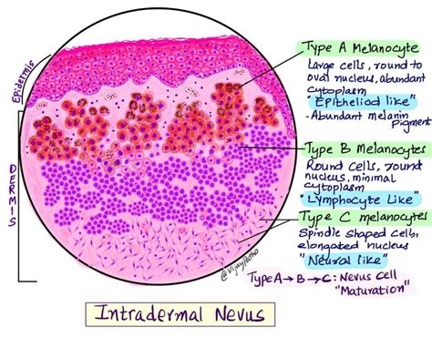 Congenital Melanocytic Nevus Histology