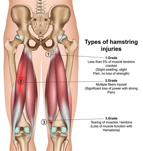 Hamstring Tendon