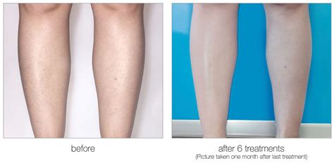 Calgary Laser Hair Removal - Flawless Laser and Body Sculpting