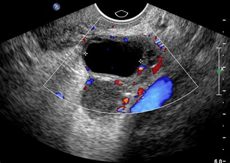 Tubo Ovarian Abscess On Ultrasound