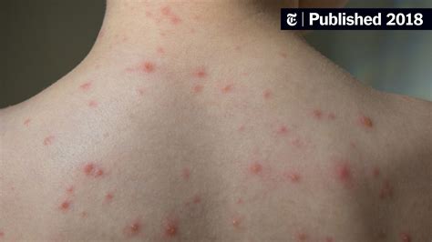 Chickenpox Outbreak at School Linked to Vaccine Exemptions - The New ...