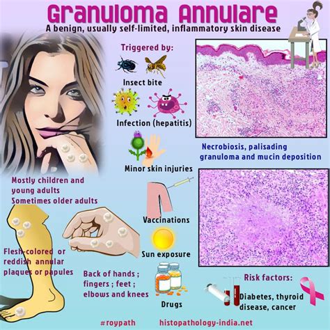 Pathology of Granuloma Annulare | Granuloma annulare, Pathology ...