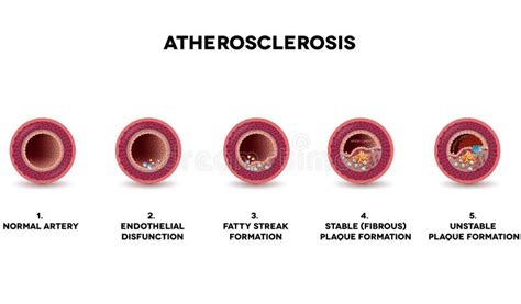 The 4 Stages Of Atherosclerosis