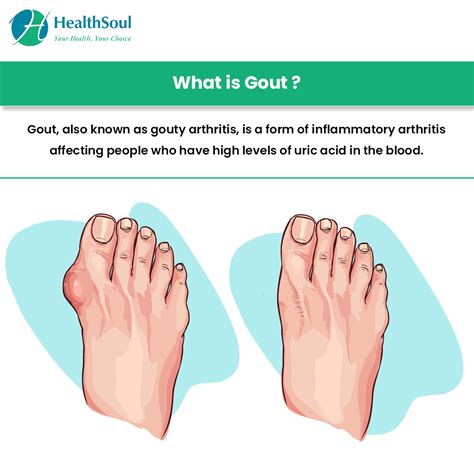 Gout: Causes, Symptoms and Treatment – Healthsoul