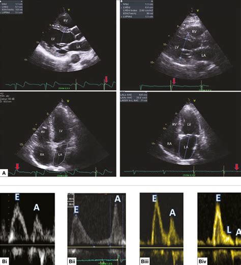 RACGP - Heart failure with preserved ejection fraction