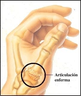 ARTRITIS DEL PULGAR - Cirugia de Columna en Matamoros