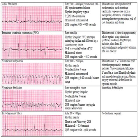 13 Cardiac Rhythm and Dysrhythmias Cheat Sheet Any Nurse Must | Etsy Israel