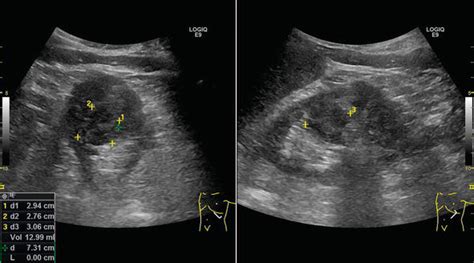 Harmonic Contrast-Enhanced Ultrasound (CEUS) of Kidney Tumors | IntechOpen