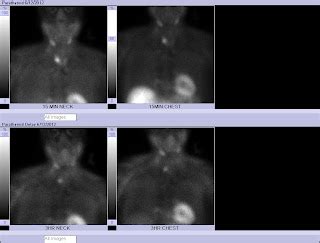 Nuclear Medicine Technology Program: Abnormal Parathyroid Scan