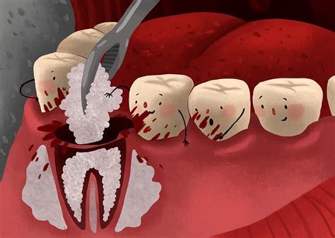 How To Sleep After Tooth Extraction And Bone Graft - Dental Implant ...