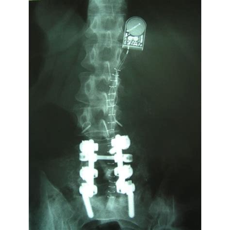 Complications of Lumbar Laminectomy | Healthfully