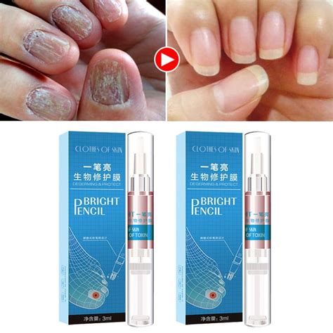 Toenail Fungus Treatment Antibacterial Nail Repair Care Pen Anti-fungal ...