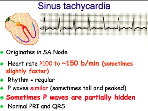 Sinus tachycardia