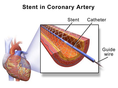 Stent - Wikipedia