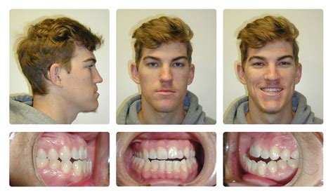 How To Fix A Crossbite And Overbite - Orthodontic Smile Gallery ...