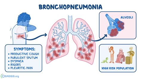 Pneumonia in young adults – Telegraph