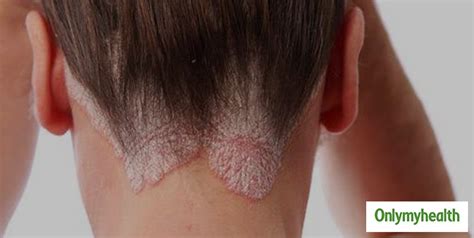 Experiencing Scabs On Scalp? Check Out These Symptoms, Causes And ...