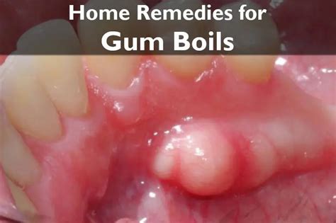 7 Powerful Home Remedies for Gum Boils: For A Quick Relief!