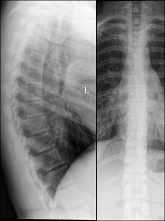 Thoracic spine (AP view) | Radiology Reference Article | Radiopaedia.org