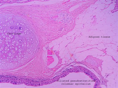 Dermoid cyst – ovary – Histopathology.guru