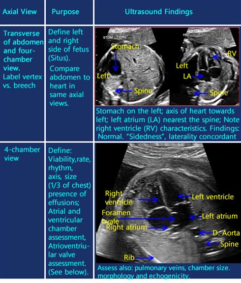 Normal Fetal Heart Ultrasound - OB Images