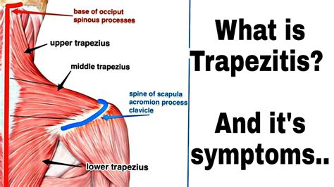 VASTRAL PHYSIOTHERAPY CLINIC: Trapezitis Pain : Physiotherapy Treatment