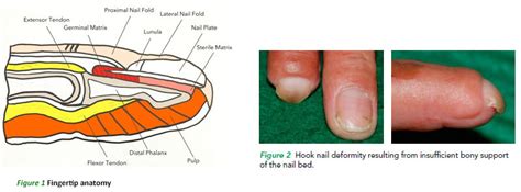 Nail Pterygium Is Caused By Damage To The - Bios Pics