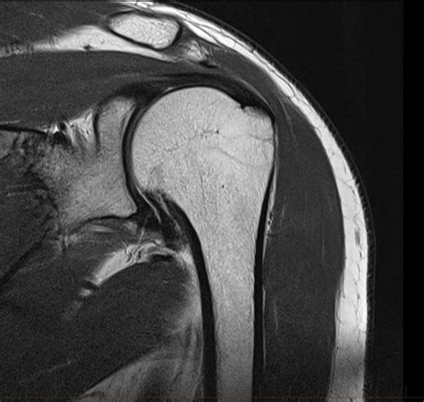 MRI of Shoulder - Rotator cuff tear - MRI at Melbourne Radiology Clinic