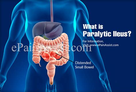 What is Paralytic Ileus & How is it Treated?|Causes, Symptoms ...